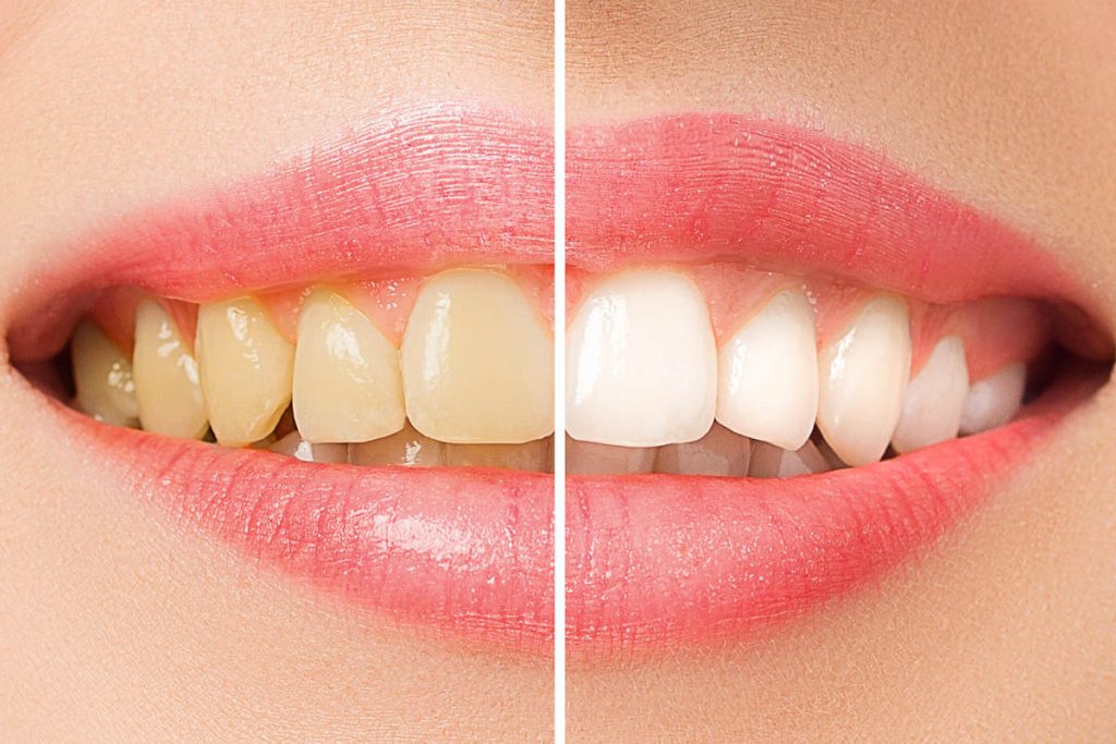 blanqueamiento dental